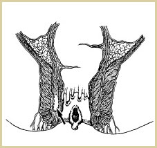 chronic fissure with skin tag